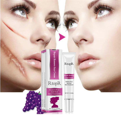 Acne Scar Removal Cream for Skin Repair and Healing