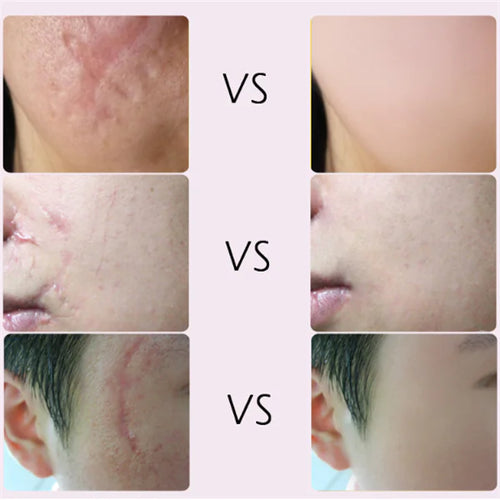 Acne Scar Removal Cream for Skin Repair and Healing