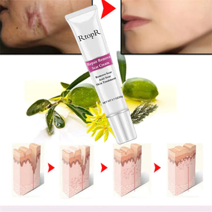 Acne Scar Removal Cream for Skin Repair and Healing