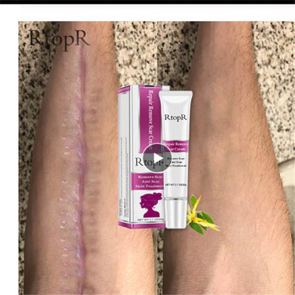 Acne Scar Removal Cream for Skin Repair and Healing